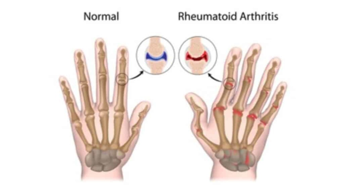 Arthritis Treatment Neurotherapy Punjab Neurotherapist Punjab 2095