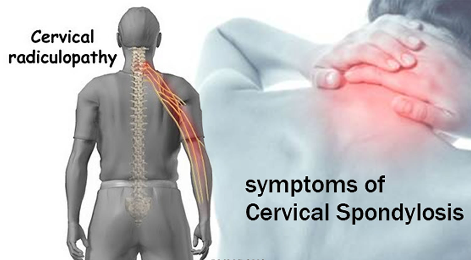 Cervical Spondylosis: What It Is, Symptoms & Treatment