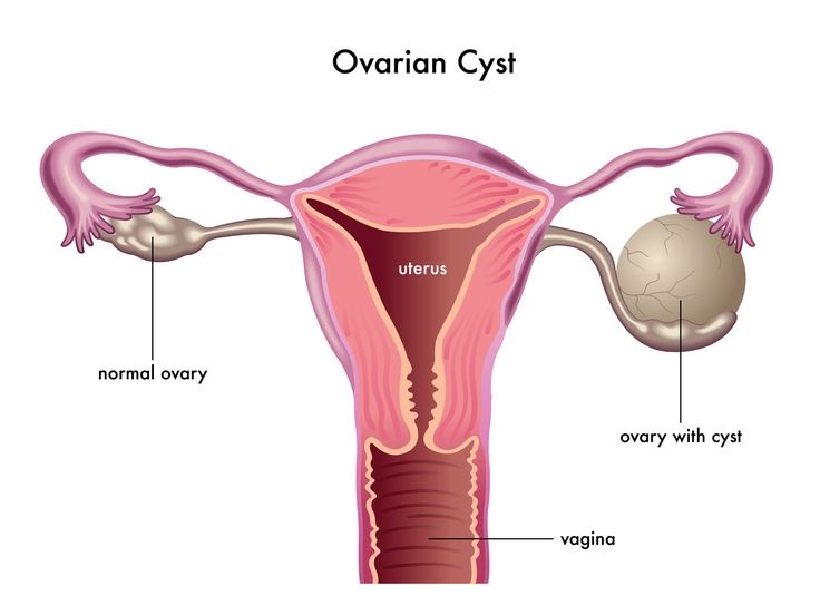 Ovarian Cyst Treatment