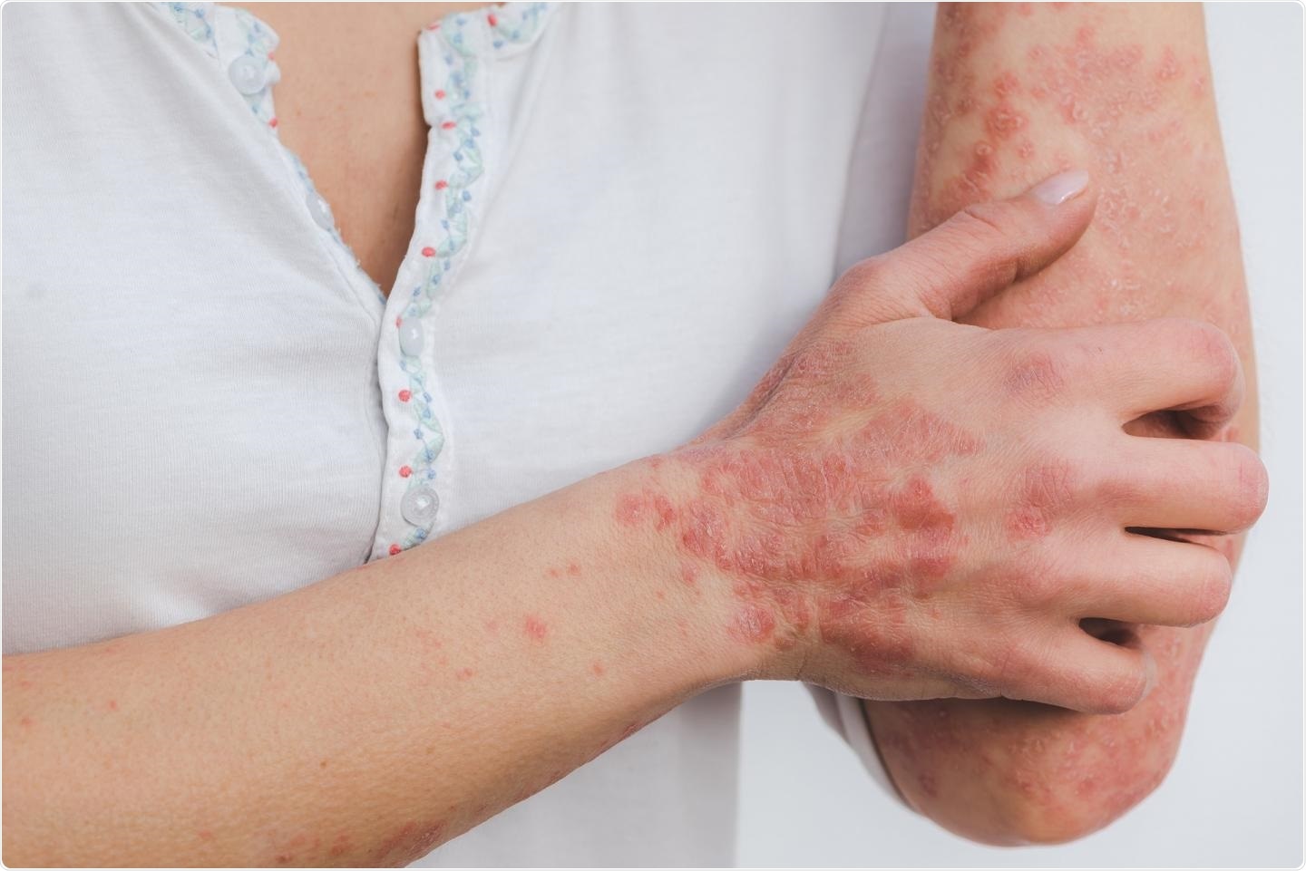 Psoriasis Treatment